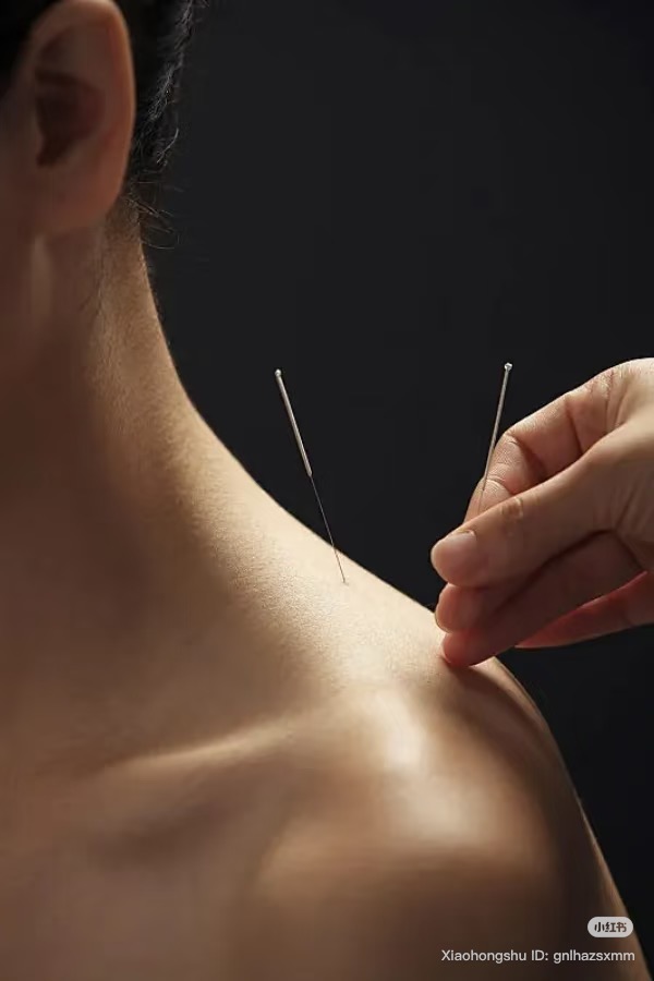 Acupuncture